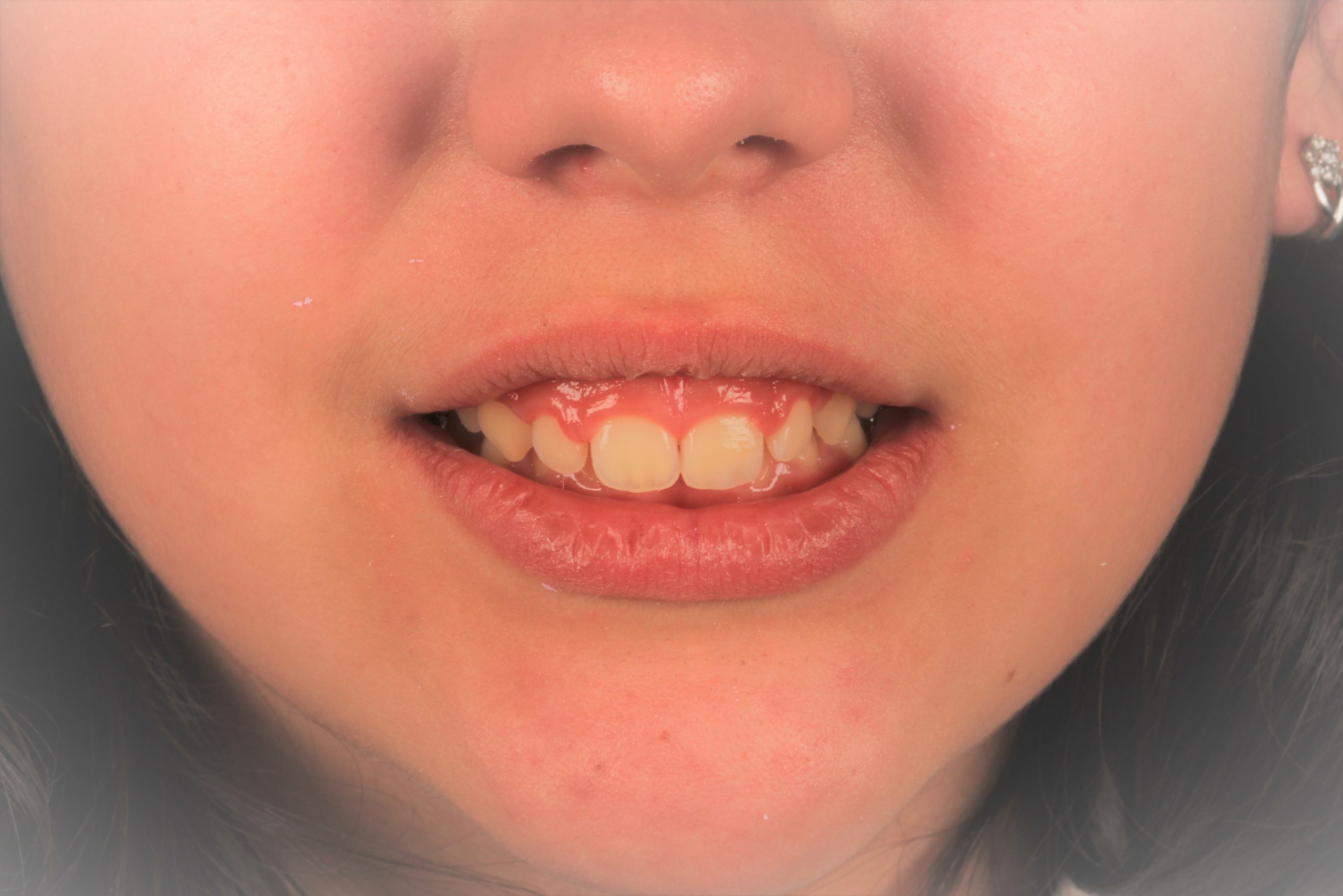 Ortodoncia Infantil. Aparatologia fija (brackets) y Gingivoplastia.|Clínica Dental Ortoperio