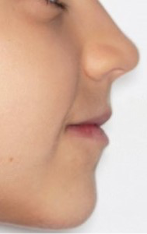 Ortodoncia Infantil. Ortopedia (Disyuntor y máscara facial) y Ortodoncia 6