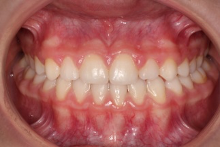 Ortodoncia Infantil. Ortopedia (Disyuntor y máscara facial) y Ortodoncia 11