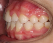 Ortodoncia Infantil. Ortopedia (Disyuntor y máscara facial) y Ortodoncia 12
