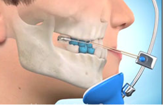Ortodoncia Infantil. Ortopedia (Disyuntor y máscara facial) y Ortodoncia 2