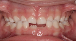 Ortodoncia Infantil. Ortopedia (Disyuntor y máscara facial) y Ortodoncia 8