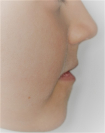 Ortodoncia Infantil. Ortopedia (Disyuntor y máscara facial) y Ortodoncia 5