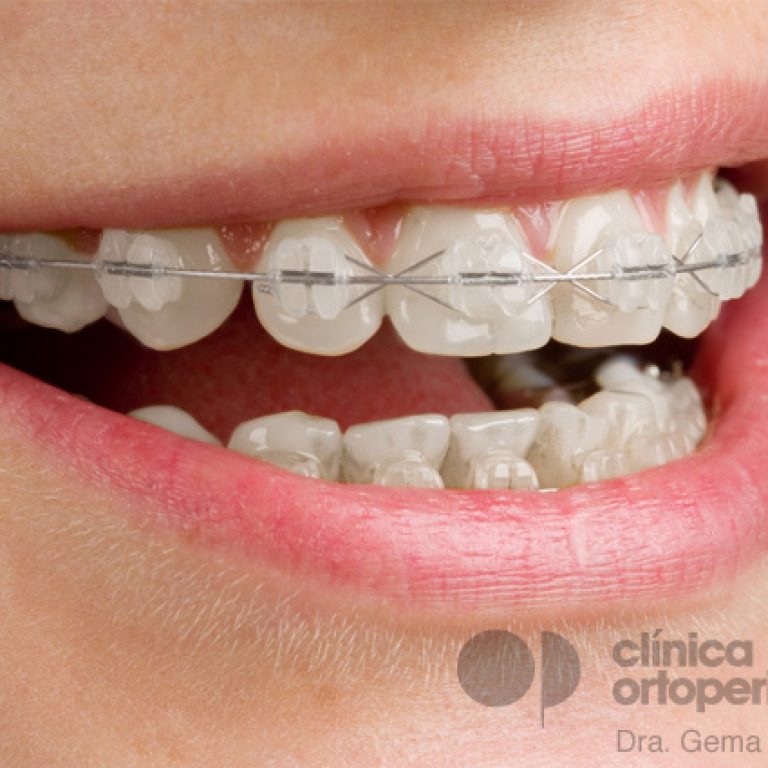 Aparatos-de-ortodoncia-en-adolescentes-y-adultos1