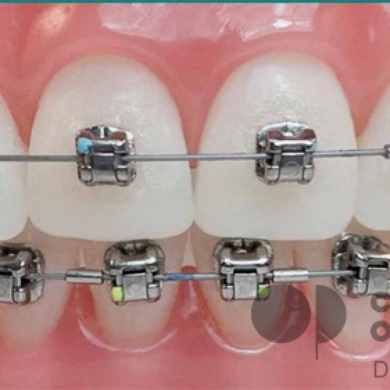 Brackets-de-autoligado.-Brackets-Damon