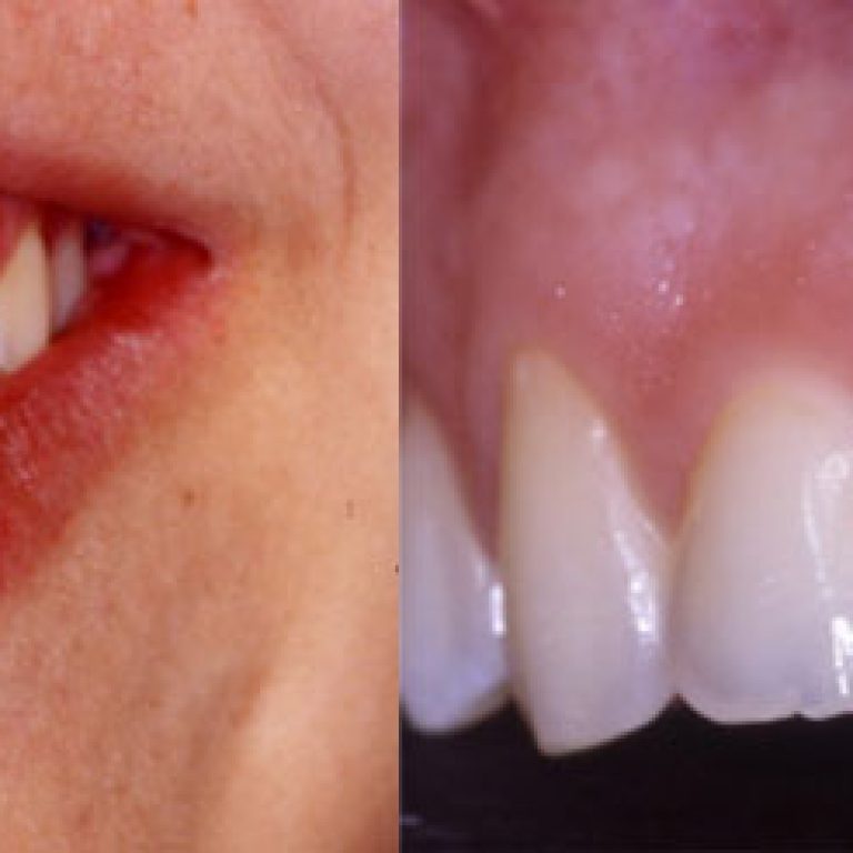 Implante-inmediato-5