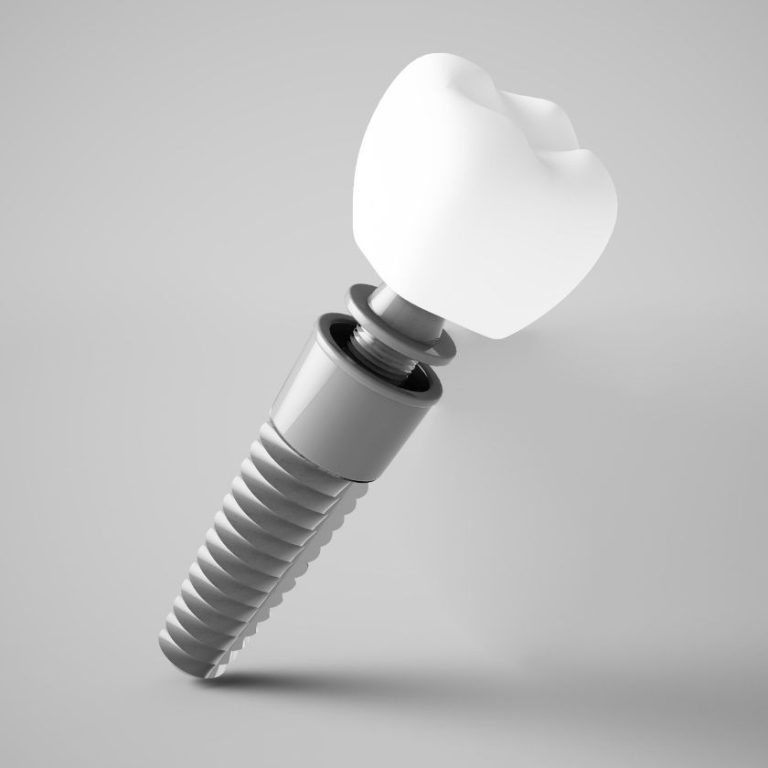 Implantes dentales inmediatos ortoperio