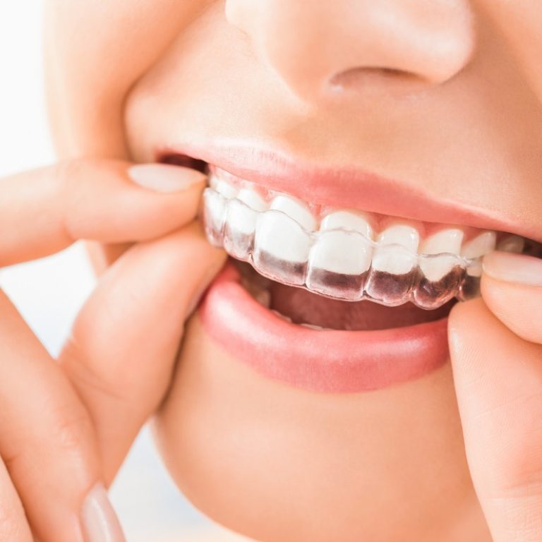 Ortodoncia Invisible en Murcia Ortoperio