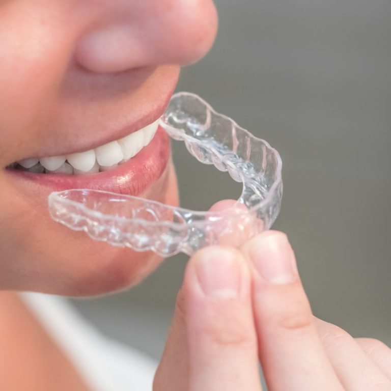 Ortodoncia invisible en Murcia Dental Ortoperio