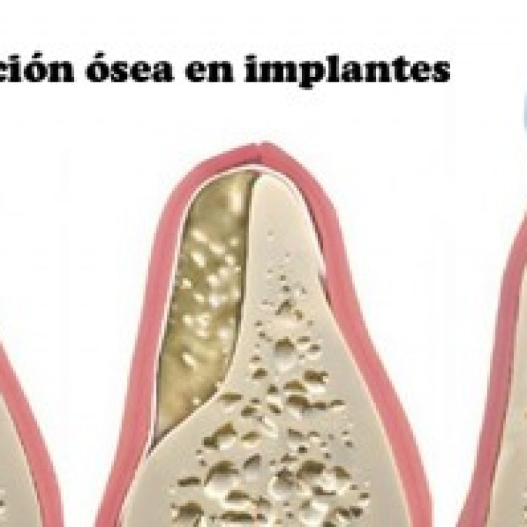 Regeneración de implantes dent copia