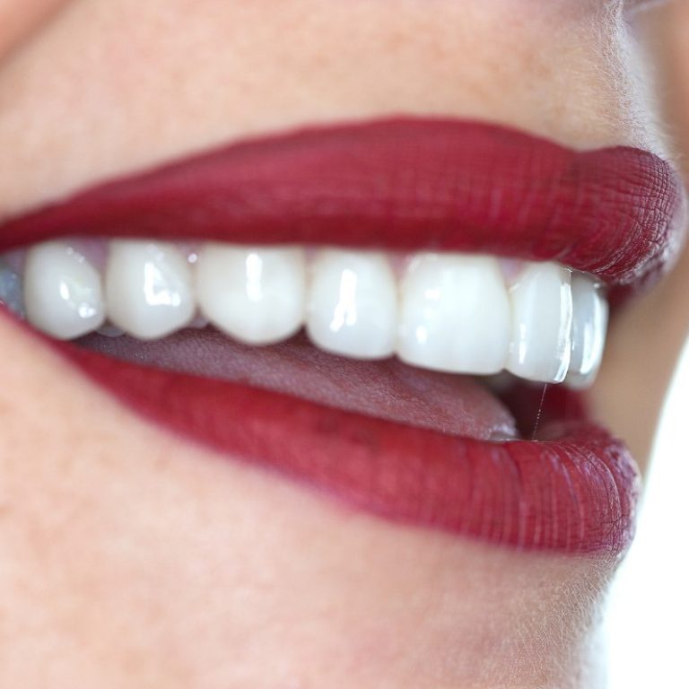 carillas dentales en Murcia Ortoperio