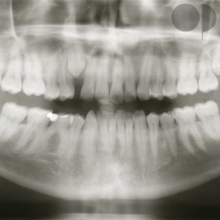 ortodoncia-dientes-impactados