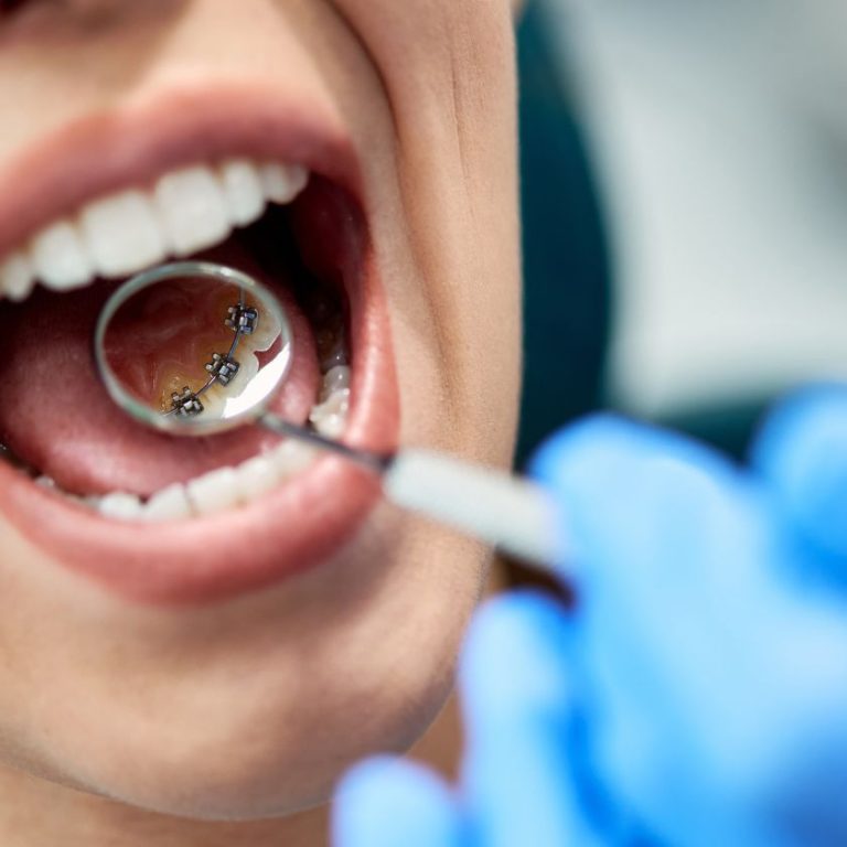 ortodoncia lingual ortoperio murcia