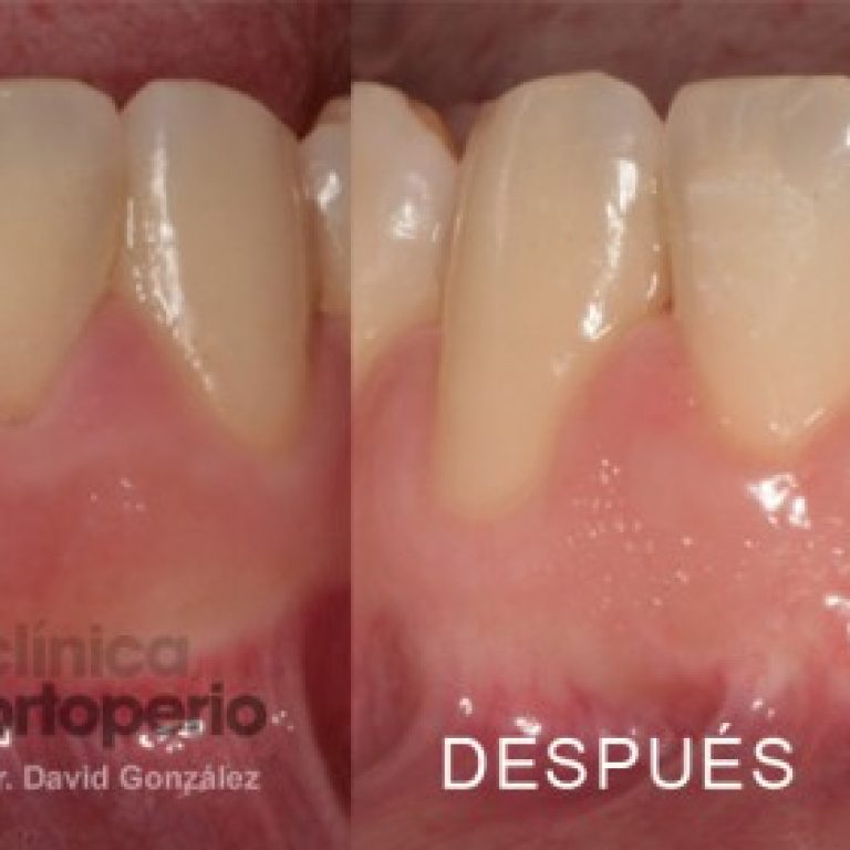 periodontitis-1024x281